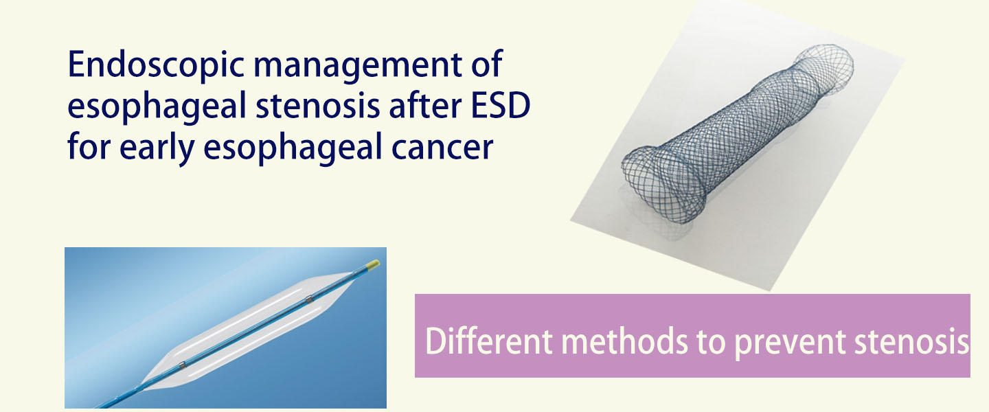 Endoscopic management of esophageal stenosis after ESD for early esophageal cancer